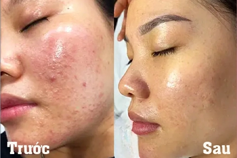 Massage trị liệu tại massage Vĩnh Yên