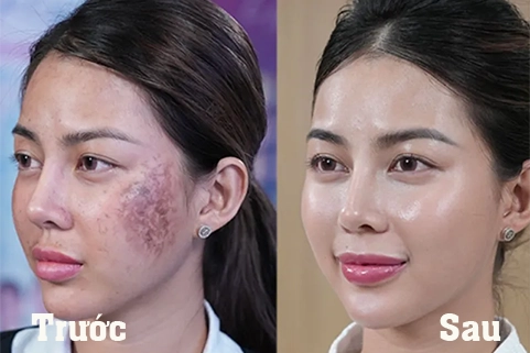Xông khô đá muối himalay tại massage Vĩnh Yên