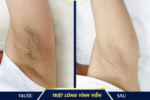 Triệt lông & Trị thâm